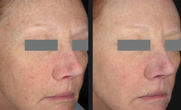 frax-pro-1940-skin-resurfacing-konica-patel-schallen-md-p2-3m-after-3txs.jpg