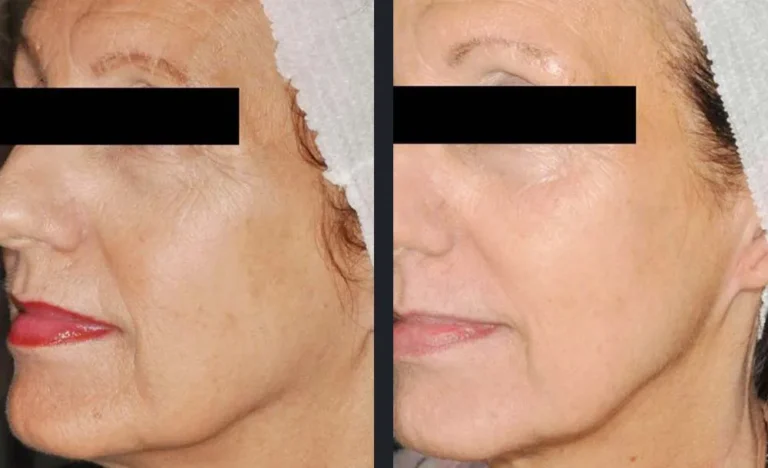 frax-pro-skin-rejuvenation-e-victor-ross-md-p2.jpg